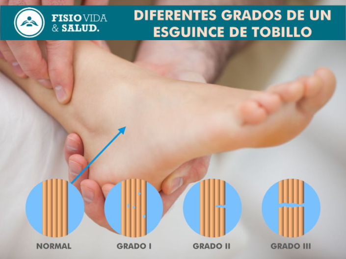 Grados en un esguince de tobillo